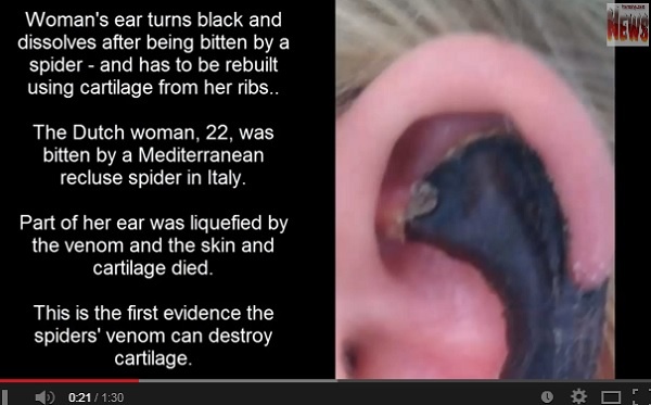 ドクイトグモに刺され耳が黒く変色した女性。　画像はYouTubeのスクリーンショット