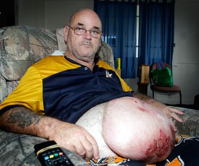 大きな腫瘍が発生したジョン・マクドナルドさん。　画像はsunshinecoastdaily.com.auより