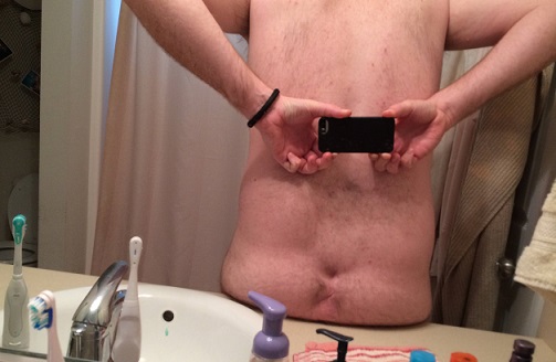 毛巣洞炎が原因で尻の割れ目を失った男性。画像はi.imgur.comのスクリーンショット