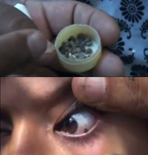目から小石が出てくるというイエメンの少女。画像はYouTubeのスクリーンショット