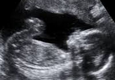 【EU発！Breaking News】胎児死亡診断の宣告を受けた妊婦。中絶処置を拒否し、別の病院で無事出産。（英）