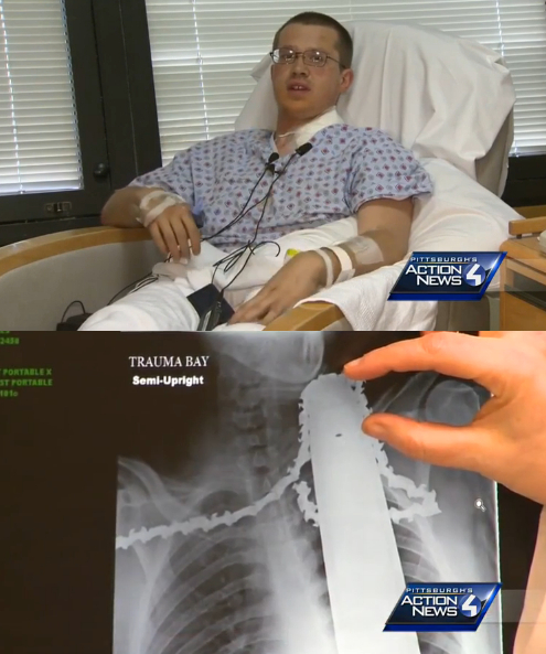 【米国発！Breaking News】チェーンソーが男性作業員の首筋へ。X線写真では頸動脈が切断寸前！（ペンシルベニア州）