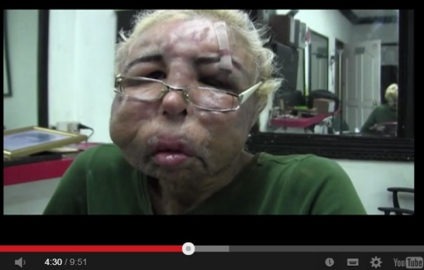 【南米発！Breaking News】美顔目的で、ベビーオイルを17年も顔に注入し続けたメキシコ人。＜動画あり＞