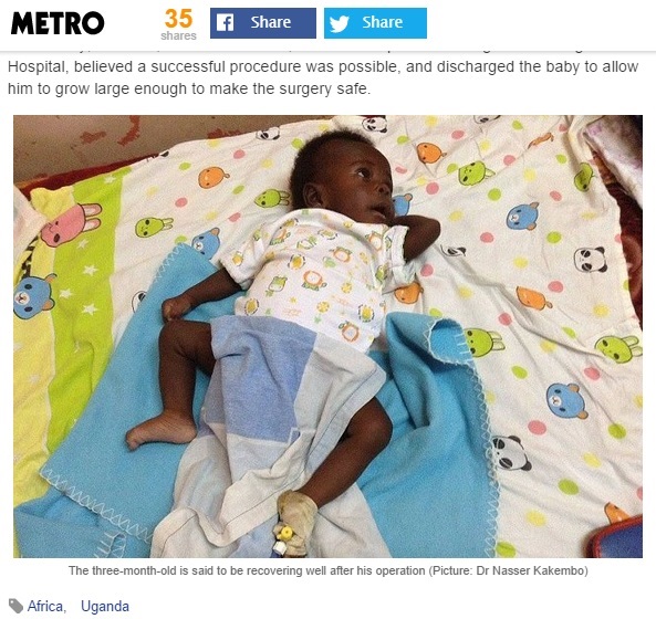 【アフリカ発！Breaking News】手足が8本。ウガンダで生まれた赤ちゃん、切除手術が無事成功。