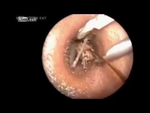 インド人男性の耳の奥に大きな虫（画像はYouTubeのサムネイル）