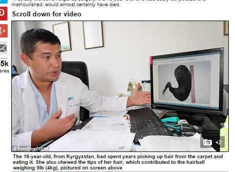 【海外発！Breaking News】4kgの毛髪が18歳少女の胃に！　「カーペットに落ちている髪を食べ続けた」（キルギス共和国）