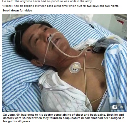 【海外発！Breaking News】40年前の刺鍼術が原因。男性の体に残り苦しめていた3cmのハリ。（中国）