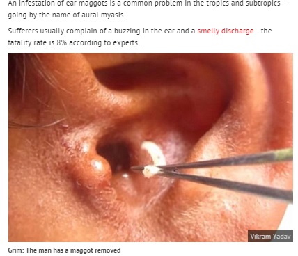 【海外発！Breaking News】耳の穴にハエのうじ虫が！　「寝ている間に侵入」と耳鼻科医も警鐘。（印）