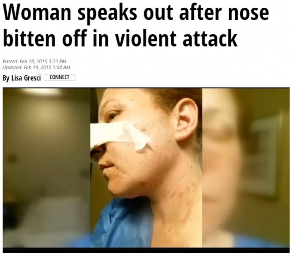 元・交際相手に鼻を噛みちぎられた女性（画像はwmbfnews.comのスクリーンショット）