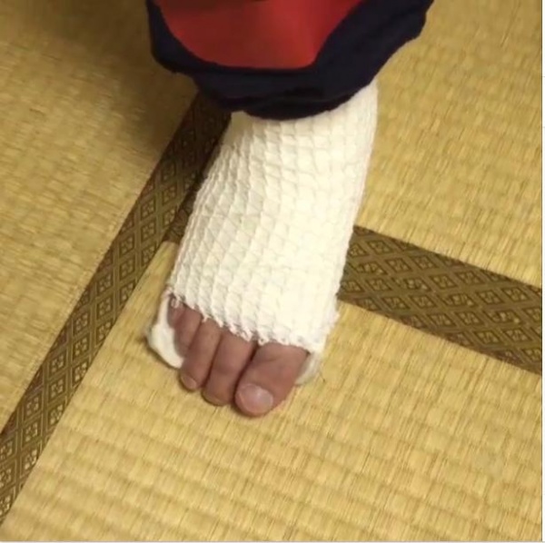 出川哲朗が骨折した右足（画像は『岡村隆史 Instagram』より）
