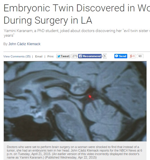 脳腫瘍の正体は双子の片方の胚だった（画像はnbclosangeles.comのスクリーンショット）