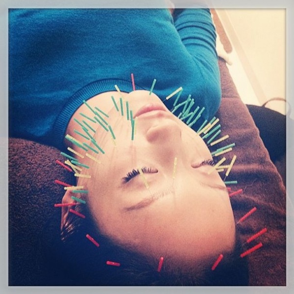【エンタがビタミン♪】NMB48・梅田彩佳が“美容鍼”する姿を披露。針だらけの顔に「ハリセンボンみたい！」