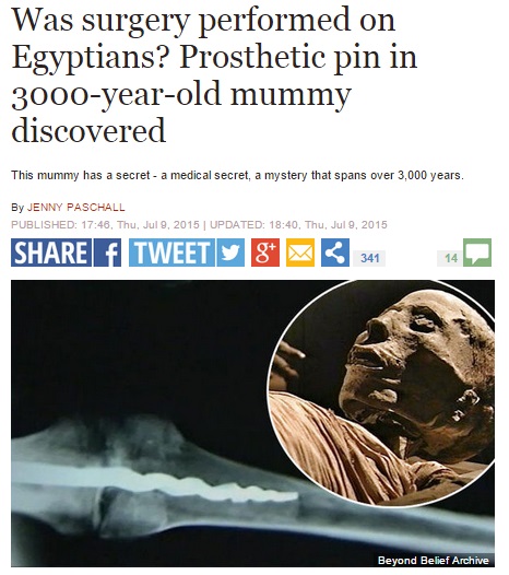 古代エジプト人の膝内にボルト（画像はexpress.co.ukのスクリーンショット）