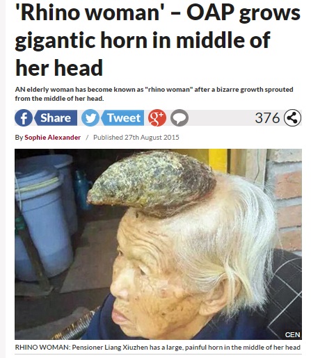 【海外発！Breaking News】頭から13cmものツノが生えている中国の87歳女性、「皮角」と診断。