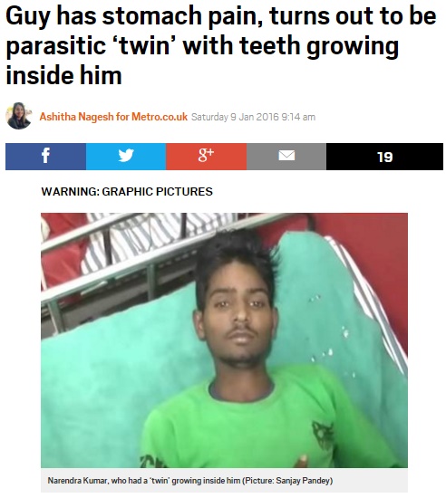 【海外発！Breaking News】歯、髪、骨が塊となって　インドの青年、腹痛の原因は「寄生性双生児」
