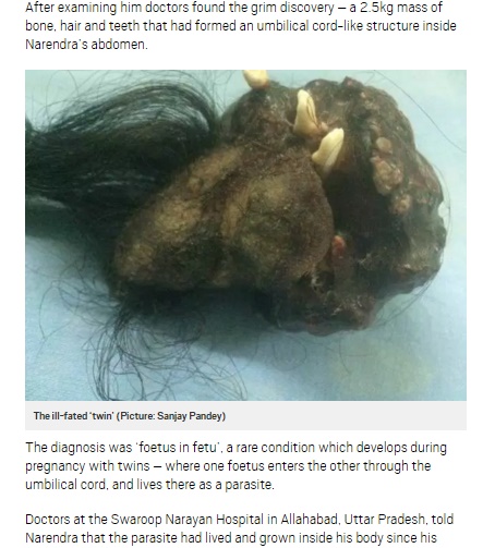 【海外発！Breaking News】歯、髪、骨が塊となって　インドの青年、腹痛の原因は「寄生性双生児」