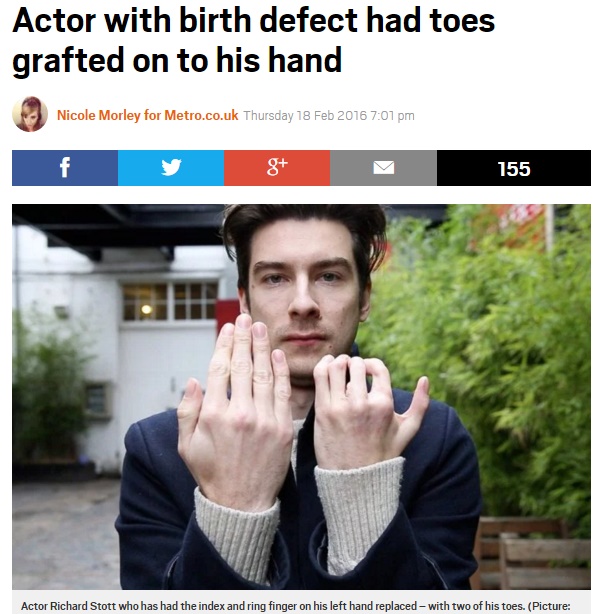 【海外発！Breaking News】先天性の手指欠損を克服　イケメン舞台俳優として生きる英28歳