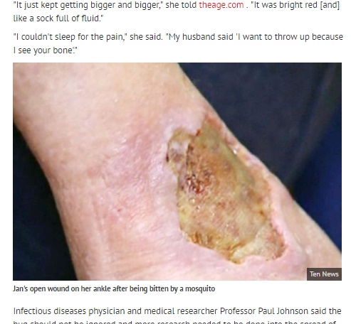人食いバクテリア同様に恐ろしい「ブルーリ潰瘍」が豪で流行か（出典：http://www.mirror.co.uk）