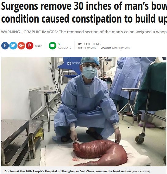 先天性の腸疾患か（画像は『Mirror Online　2017年6月9日付「Surgeons remove 30 inches of man’s bowel after rare condition caused constipation to build up over 22 years」（Photo: AsiaWire）』のスクリーンショット）