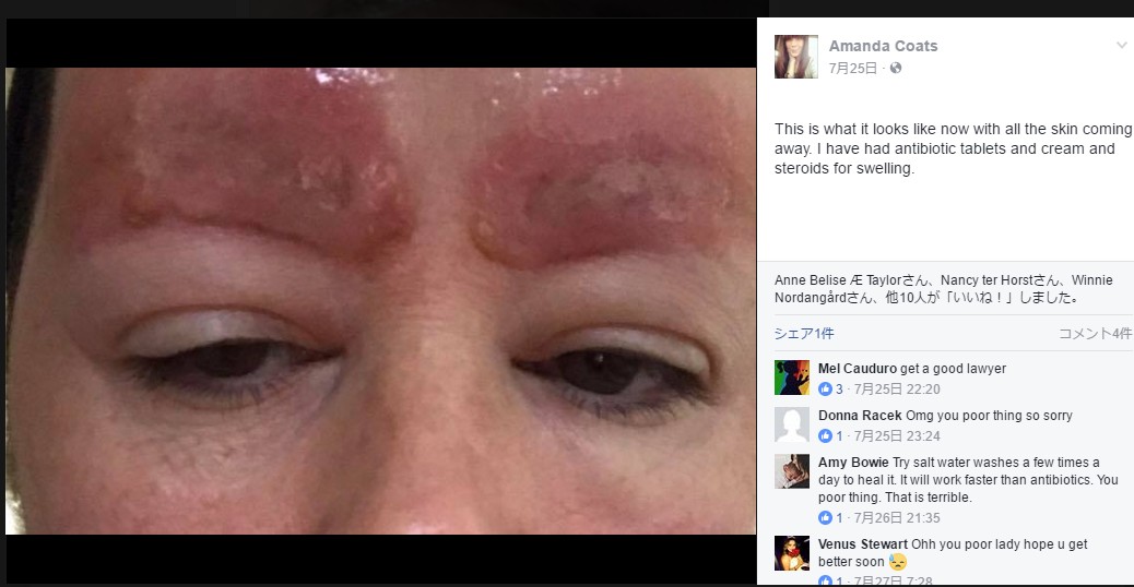 眉タトゥーによって治療費は14万円超に（画像は『Amanda Coats　2017年7月25日付Facebook』のスクリーンショット）