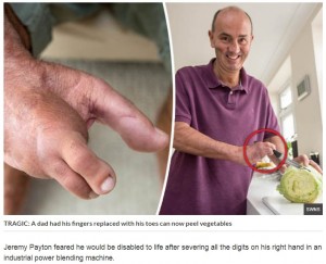 右手で包丁も使えるように（画像は『Daily Star　2017年9月5日付「GRAPHIC: Dad has fingers replaced with toes after HORROR accident – but can peel veg now」（SWNS）』のスクリーンショット）