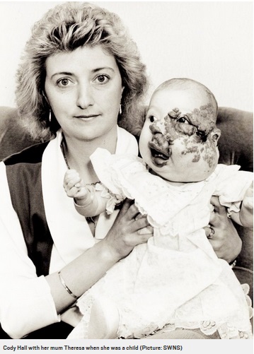 赤ちゃんの頃のコーディーさん（画像は『Metro　2017年11月18日付「Woman who had 18 operations to fix disfigured face gets married」（Picture: SWNS）』のスクリーンショット）
