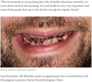 ボロボロだったマイケルさんの歯（画像は『The Irish Times　2018年1月22日付「Man with fizzy drink addiction gets 27 rotten teeth removed」』のスクリーンショット）