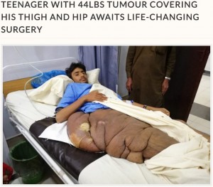 20kgの腫瘍を抱えるムハンマド＝エッサさん（画像は『Storytrender　2018年3月26日付「TEENAGER WITH 44LBS TUMOUR COVERING HIS THIGH AND HIP AWAITS LIFE-CHANGING SURGERY」（By Bilal Kuchay）』のスクリーンショット）