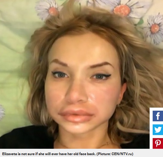 施術に失敗し唇が腫れ上がってしまったエリザベータさん（画像は『Metro　2018年4月18日付「Woman left with swollen, bruised, burst lips after injections went wrong」（Picture: CEN/NTV.ru）』のスクリーンショット）