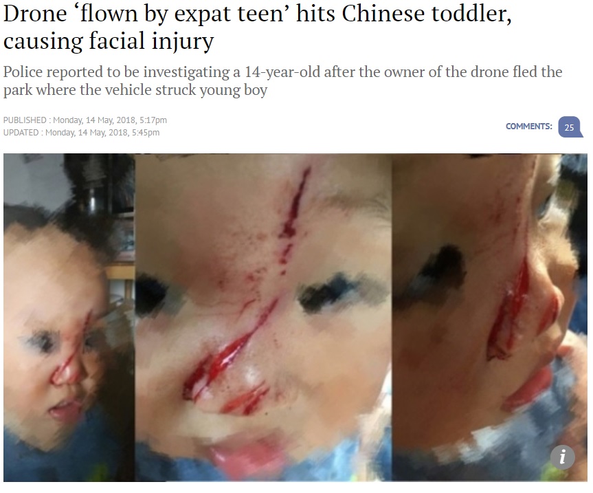 大怪我をした1歳のChengChengくん（画像は『South China Morning Post　2018年5月14日付「Drone ‘flown by expat teen’ hits Chinese toddler, causing facial injury」』のスクリーンショット）
