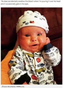 昨年10月に退院したばかりのジェイミソン君（画像は『Metro　2018年6月20日付「Mum bathes her baby in bleach twice a week to help him fight infection」（Picture: Alicia Barber / SWNS.com）』のスクリーンショット