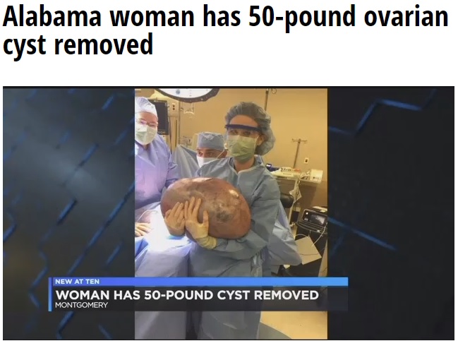 摘出された卵巣嚢腫（画像は『WSFA 12 News　2018年6月28日付「Alabama woman has 50-pound ovarian cyst removed」』のスクリーンショット）