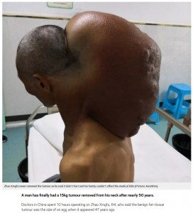 首に15kgもの腫瘍を47年間抱えていたシンフーさん（画像は『Metro　2018年5月31日付「Man’s massive neck tumour has been growing for 47 years」（Picture: AsiaWire）』のスクリーンショット）
