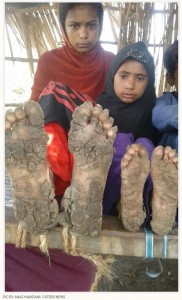 稀な疾患により手足の皮膚が石化していく子供たち（画像は『Storytrender　2018年6月11日付「RARE SKIN DISEASE IS TURNING FEET AND HANDS OF THESE SIBLINGS INTO STONE」（PIC BY ANAS HAMDANI/ CATERS NEWS）』のスクリーンショット）