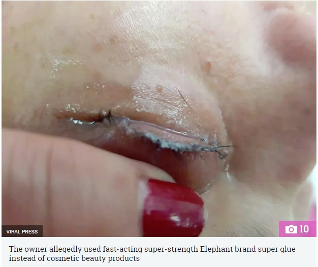 瞬間接着剤で悲惨な状態に…（画像は『The Sun　2018年8月13日付「OH EYE GOD Woman’s agony after backstreet beautician uses SUPERGLUE to apply eyelash extensions」』のスクリーンショット）
