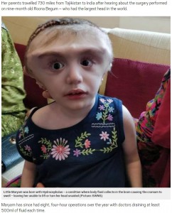 手術を受け頭を支えることができるようになったマリアムちゃん（画像は『Metro　2018年8月22日付「Girl, 2, undergoes pioneering surgery in bid to shrink head（Picture：SWNS）』のスクリーンショット）