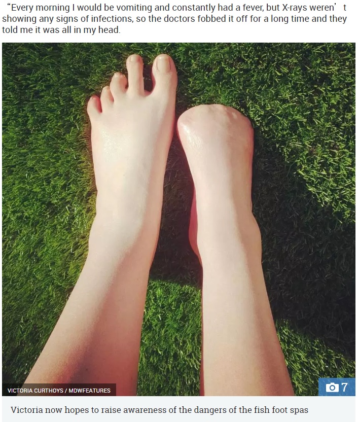 ヴィクトリアさんの現在の足（画像は『The Sun　2018年9月13日付「HOLIDAY FROM HELL Woman’s horror after visit to Thai fish spa left her foot with flesh-rotting infection that required her toes to be amputated」（IMAGE: VICTORIA CURTHOYS / MDWFEATURES）』のスクリーンショット）