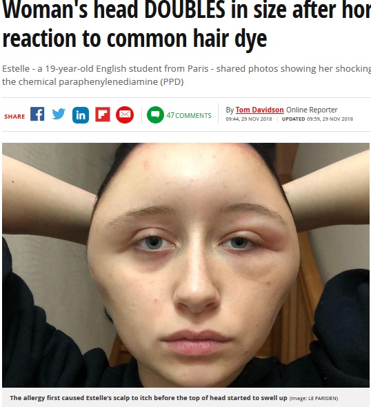 染髪剤でアレルギー反応を起こし顔が腫れ上がったエステルさん（画像は『Mirror　2018年11月29日付「Woman’s head DOUBLES in size after horrific allergic reaction to common hair dye」（Image: LE PARISIEN）』のスクリーンショット）