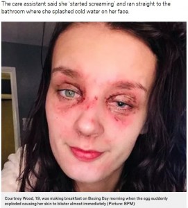 ゆで卵が爆発し顔に火傷を負ったコートニー・ウッドさん（画像は『Metro　2018年12月30日付「Girl, 19, ‘blinded’ after boiled egg exploded in her face」（Picture: BPM）』のスクリーンショット）