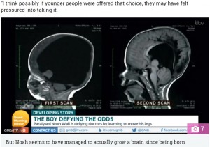 ノア・ウォール君の頭部レントゲン写真（画像は『The Sun　2019年2月20日付「THE BOY WITH ‘NO BRAIN’ Boy born with MISSING brain defies huge odds to live - after ‘it GREW back’」（Credit: GMB/ITV）』のスクリーンショット）