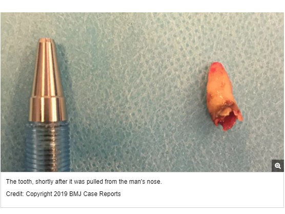 鼻の奥に生えていた歯（画像は『Live Science　2019年2月27日付「A Man’s Trouble Smelling Was Caused By a Tooth Growing in His Nose」（Credit: Copyright 2019 BMJ Case Reports）』のスクリーンショット）