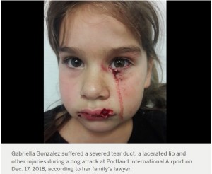顔の再建手術を要するほどの傷を負ったガブリエラちゃん（画像は『oregonlive.com　2019年2月26日付「‘Emotional support animal’ mauls 5-year-old girl at Portland airport, ＄1.1 million lawsuit says」』のスクリーンショット）