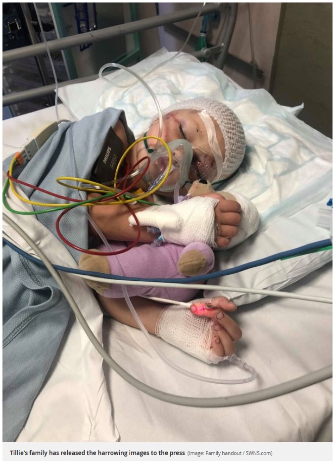 ピットブルに襲われたティリーちゃん（画像は『Mirror　2019年3月22日付「Horrific injuries of girl, 4, after crazed pitbull savaged her ‘like a ragdoll’」（Image: Family handout / SWNS.com）』のスクリーンショット）