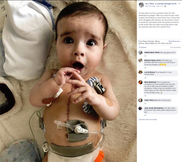 誕生後は2度の手術に耐えたアイヴィーちゃん（画像は『Ivy’s Story: A Journey through HLHS　2019年3月19日付Facebook「G-tube baby!」』のスクリーンショット）