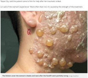 女性の顔が水ぶくれだらけに（画像は『Mirror　2019年4月23日付「Woman’s face left covered in blisters after botched plastic surgery」（Image: AsiaWire）』のスクリーンショット）