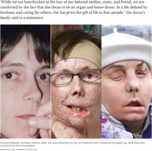 元夫から酸攻撃を受ける前と後、移植後のカルメンさんの顔（画像は『CBS News　2013年5月1日付「Woman burned with lye by ex-husband unveils new face transplant」（BRIGHAM AND WOMEN’S HOSPITAL）』のスクリーンショット）
