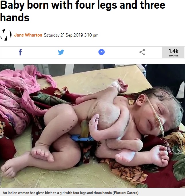 4本の脚と3本の手を持って生まれた女児（画像は『Metro　2019年9月21日付「Baby born with four legs and three hands」（Picture: Caters）』のスクリーンショット）