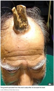 5年前から角が生え始めたシャムさん（画像は『The Sun　2019年9月18日付「LIFE OF HELL Terrifying four-inch ‘devil horn’ growing from the top of man’s head is finally removed by doctors」（Credit: SWNS:SOUTH WEST NEWS SERVICE）』のスクリーンショット）