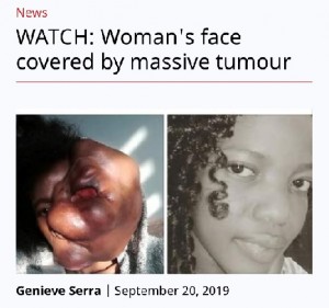 顔の3分の2以上が腫瘍で覆われてしまったマクエラさん（画像は『The Daily Voice　2019年9月20日付「WATCH: Woman’s face covered by massive tumour」』のスクリーンショット）