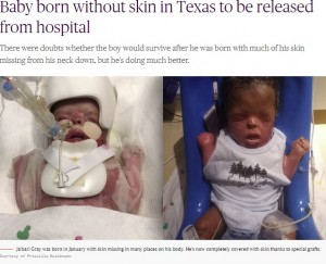 皮膚移植前（左）と手術後のジュバリ君（画像は『Today　2019年10月12日付「Baby born without skin in Texas to be released from hospital」（Courtesy of Priscilla Maldonado）』のスクリーンショット）